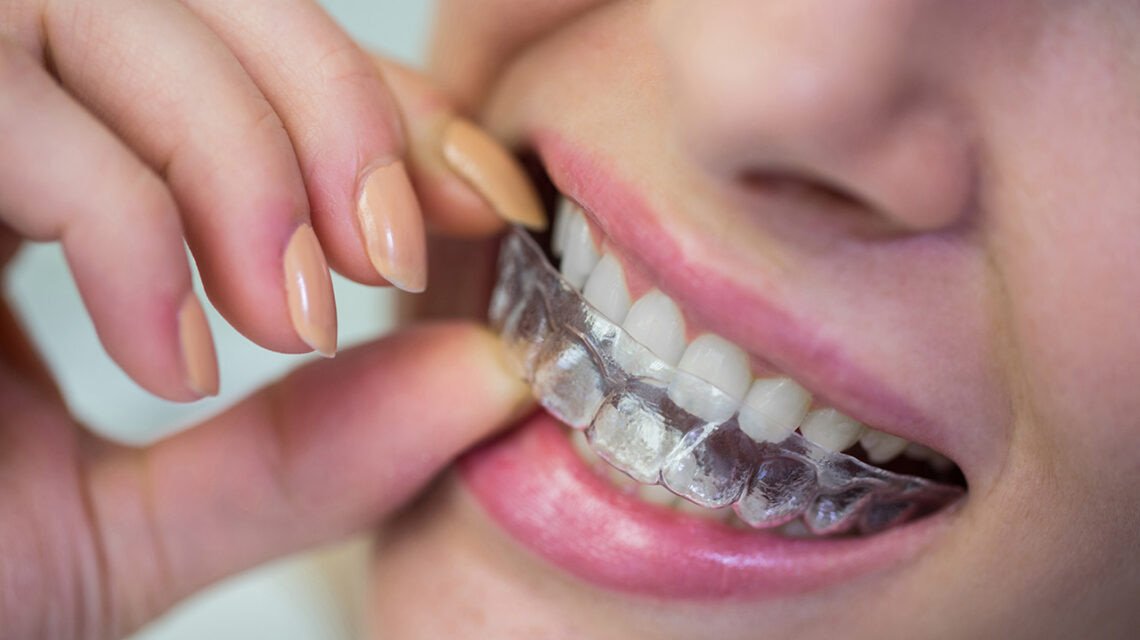 Placa para bruxismo e avaliação de apertamento dental