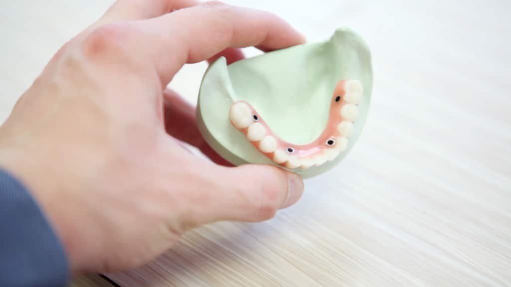 Modelo de implante dentário usado em orientação odontológica