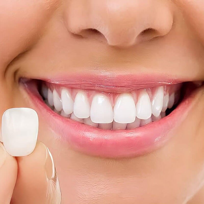 Lentes de contato dental em atendimento estético